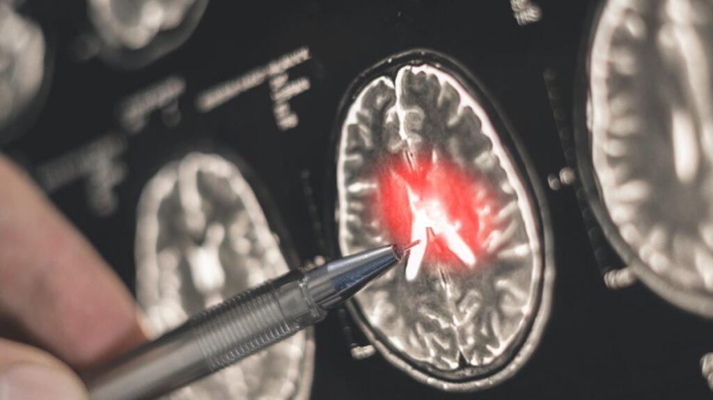 Alzheimer geni beyin damarlarını etkiliyor, geri dönüşümlü olabilir: Araştırma Alzheimer geni beyin damarlarını etkiliyor, geri dönüşümlü olabilir: Araştırma